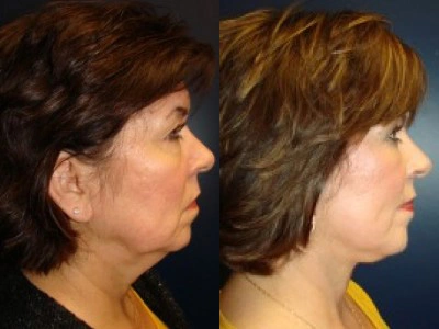 facelift 15-3